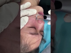 macchina del laser di picosecondo del salone di 1064nm 532nm per il trattamento di problema delle lesioni della pigmentazione della pelle