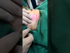 Professionale 1470nm diodo laser ridurre il grasso macchina risultati visibili in 2-3 sessioni